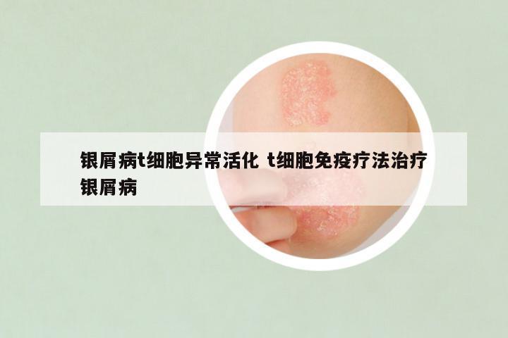 银屑病t细胞异常活化 t细胞免疫疗法治疗银屑病