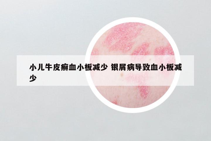 小儿牛皮癣血小板减少 银屑病导致血小板减少