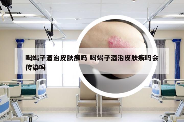 喝蝎子酒治皮肤癣吗 喝蝎子酒治皮肤癣吗会传染吗