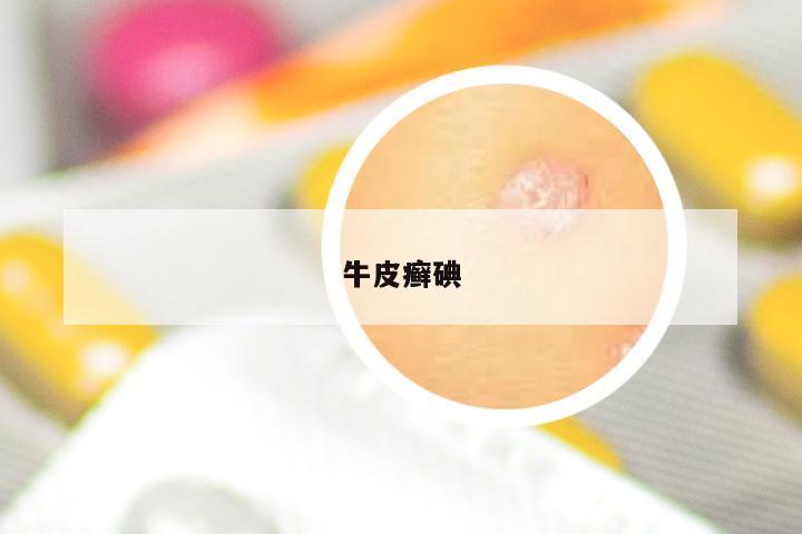 牛皮癣碘