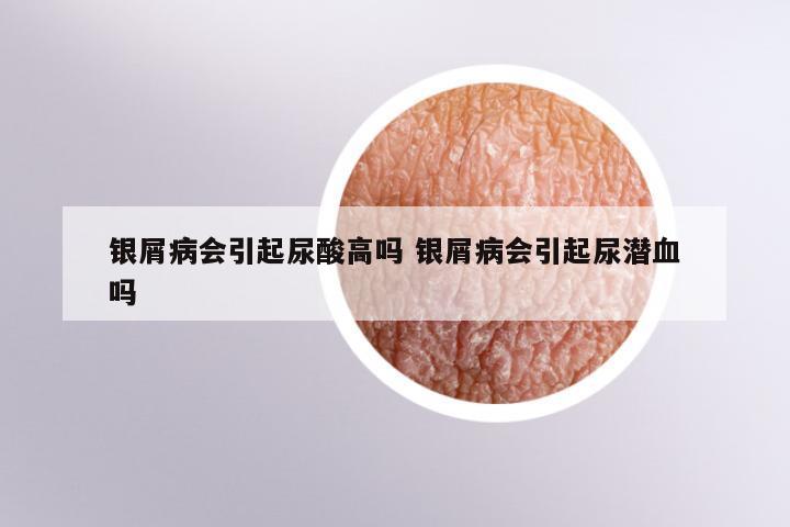 银屑病会引起尿酸高吗 银屑病会引起尿潜血吗