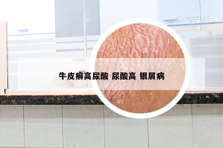 牛皮癣高尿酸 尿酸高 银屑病