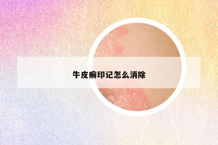 牛皮癣印记怎么消除