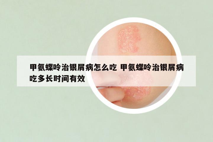 甲氨蝶呤治银屑病怎么吃 甲氨蝶呤治银屑病吃多长时间有效