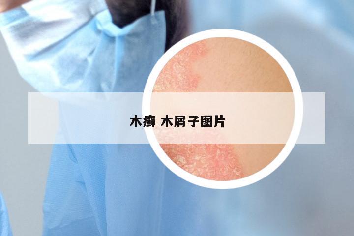 木癣 木屑子图片