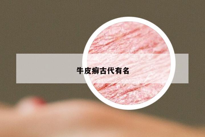 牛皮癣古代有名