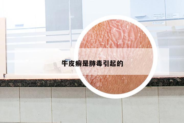 牛皮癣是肺毒引起的