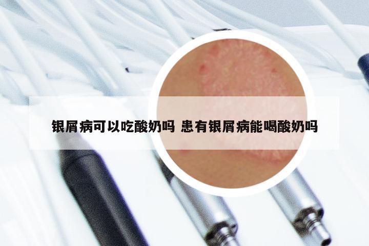 银屑病可以吃酸奶吗 患有银屑病能喝酸奶吗