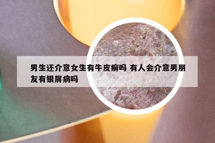 男生还介意女生有牛皮癣吗 有人会介意男朋友有银屑病吗