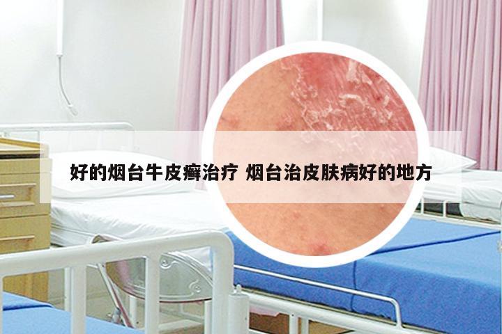 好的烟台牛皮癣治疗 烟台治皮肤病好的地方