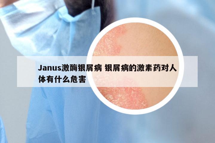 Janus激酶银屑病 银屑病的激素药对人体有什么危害