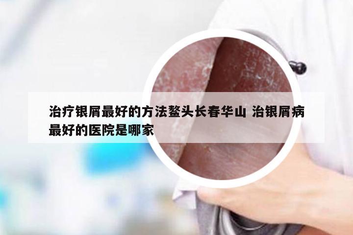 治疗银屑最好的方法鳌头长春华山 治银屑病最好的医院是哪家