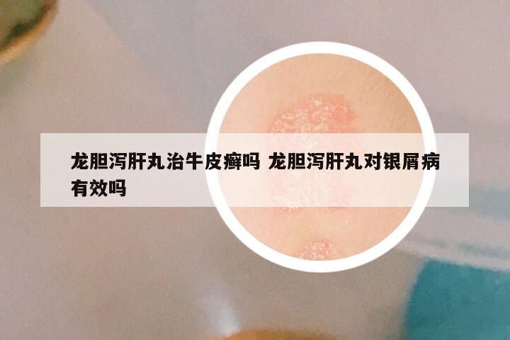 龙胆泻肝丸治牛皮癣吗 龙胆泻肝丸对银屑病有效吗