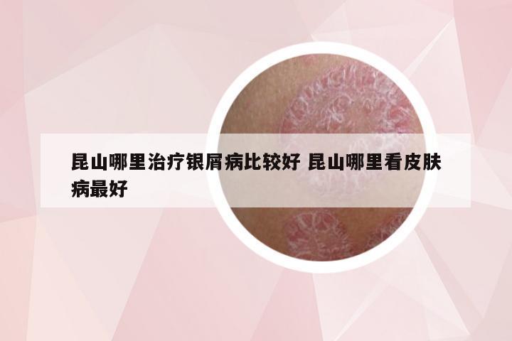 昆山哪里治疗银屑病比较好 昆山哪里看皮肤病最好