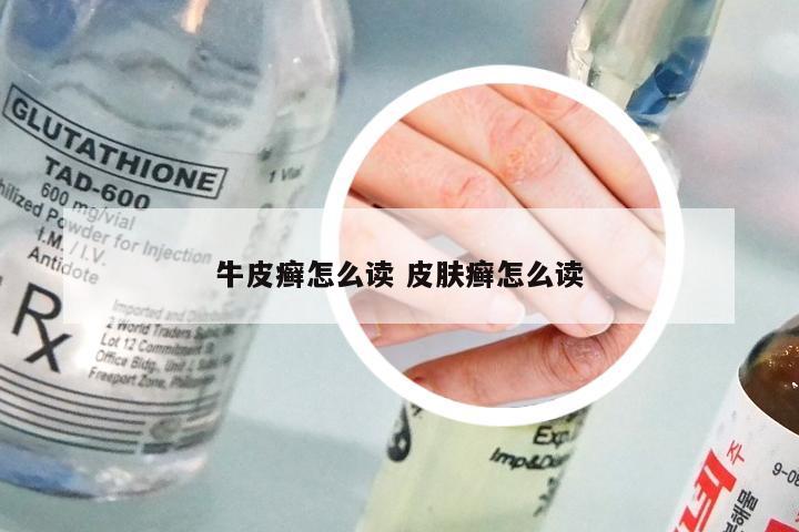 牛皮癣怎么读 皮肤癣怎么读