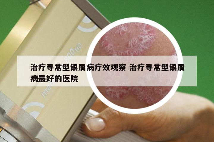 治疗寻常型银屑病疗效观察 治疗寻常型银屑病最好的医院