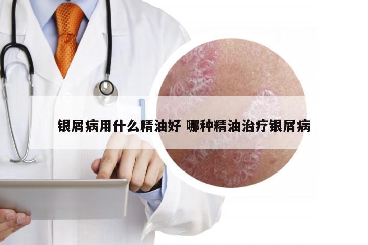 银屑病用什么精油好 哪种精油治疗银屑病
