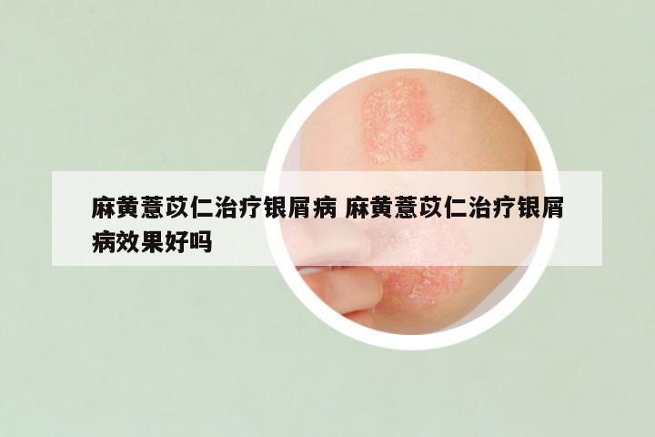 麻黄薏苡仁治疗银屑病 麻黄薏苡仁治疗银屑病效果好吗