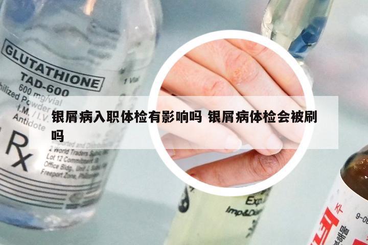银屑病入职体检有影响吗 银屑病体检会被刷吗