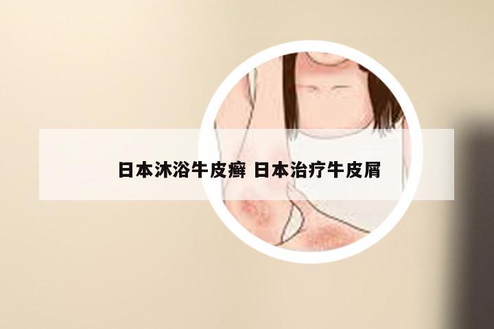 日本沐浴牛皮癣 日本治疗牛皮屑