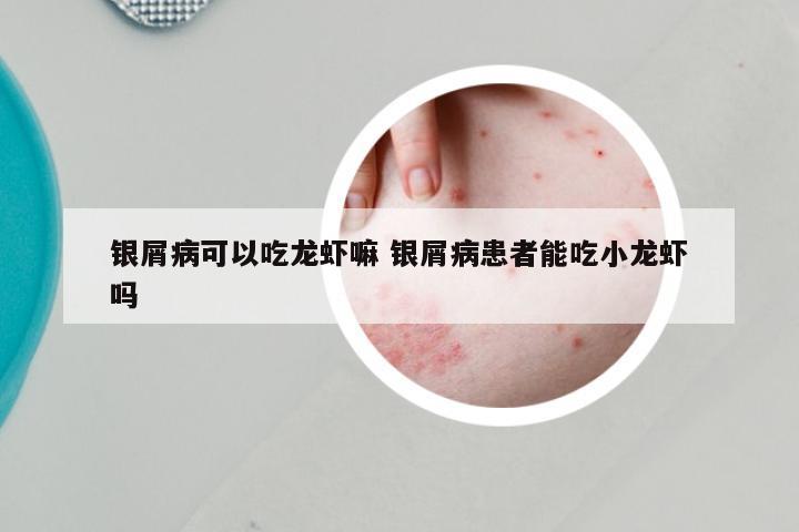 银屑病可以吃龙虾嘛 银屑病患者能吃小龙虾吗