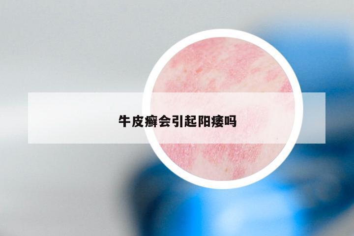 牛皮癣会引起阳痿吗