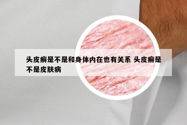 头皮癣是不是和身体内在也有关系 头皮癣是不是皮肤病