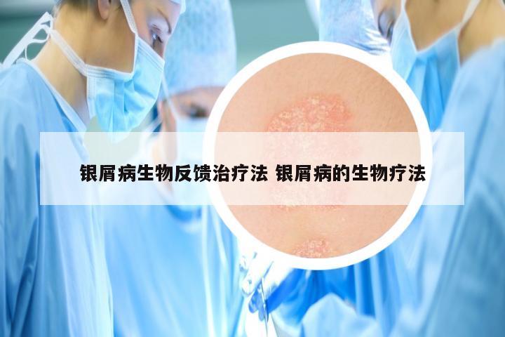 银屑病生物反馈治疗法 银屑病的生物疗法