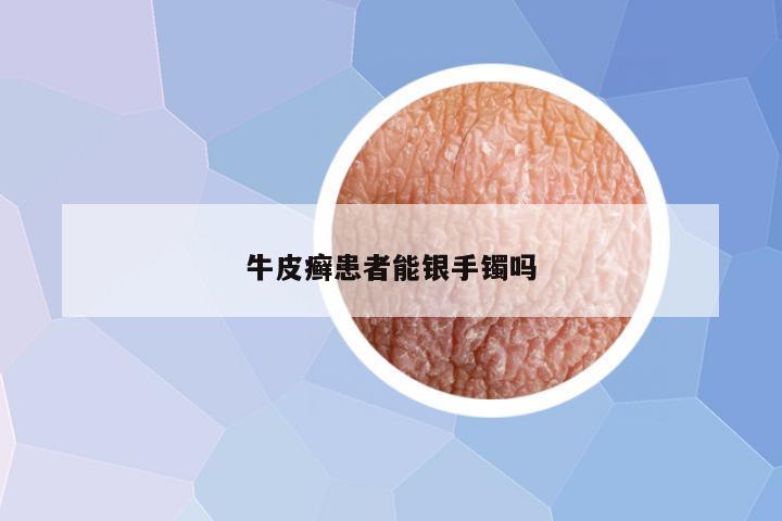 牛皮癣患者能银手镯吗
