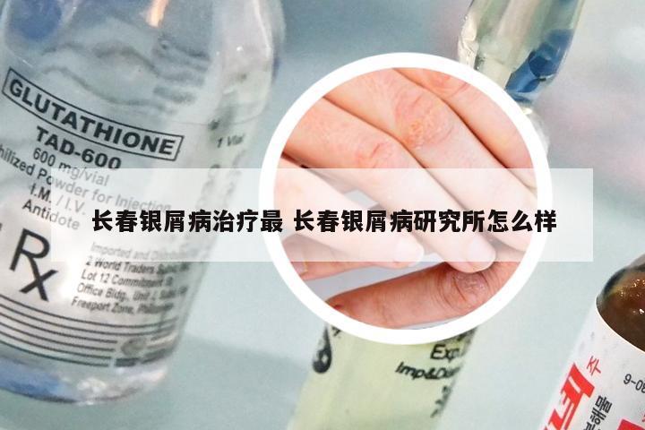 长春银屑病治疗最 长春银屑病研究所怎么样