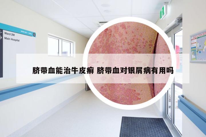 脐带血能治牛皮癣 脐带血对银屑病有用吗