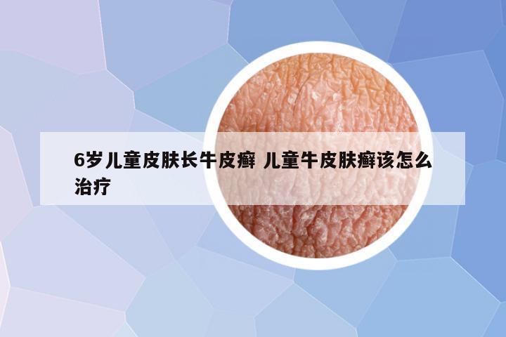 6岁儿童皮肤长牛皮癣 儿童牛皮肤癣该怎么治疗