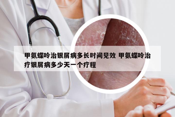 甲氨蝶呤治银屑病多长时间见效 甲氨蝶呤治疗银屑病多少天一个疗程