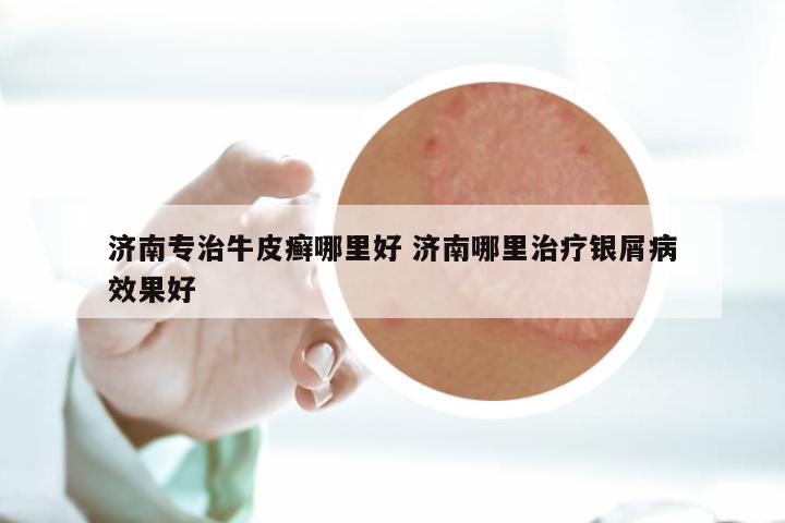 济南专治牛皮癣哪里好 济南哪里治疗银屑病效果好