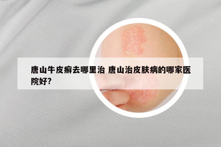 唐山牛皮癣去哪里治 唐山治皮肤病的哪家医院好?