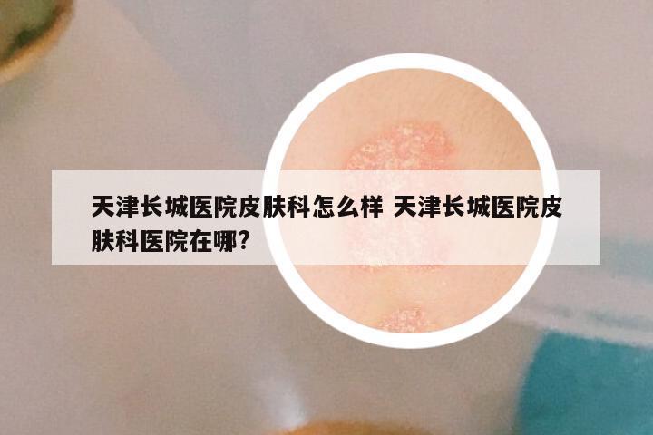 天津长城医院皮肤科怎么样 天津长城医院皮肤科医院在哪?
