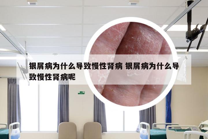 银屑病为什么导致慢性肾病 银屑病为什么导致慢性肾病呢