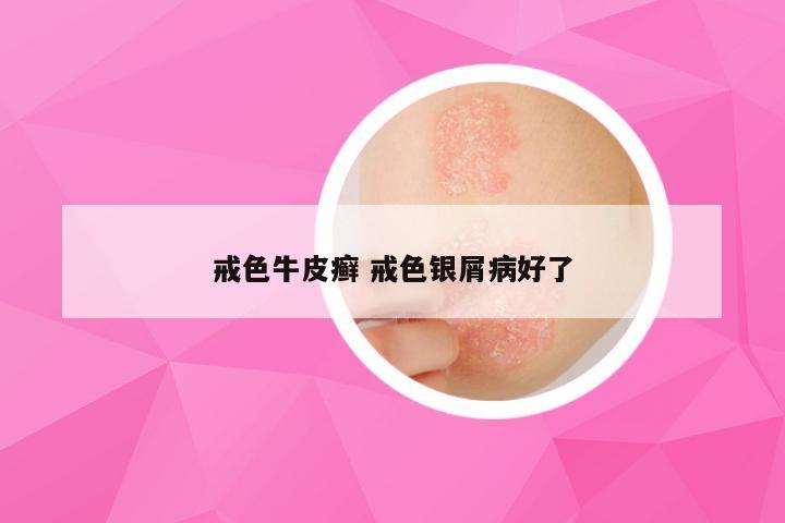 戒色牛皮癣 戒色银屑病好了