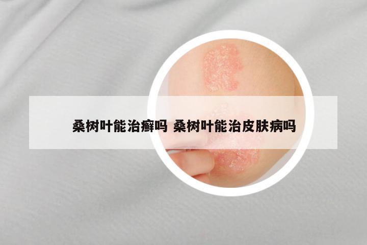 桑树叶能治癣吗 桑树叶能治皮肤病吗