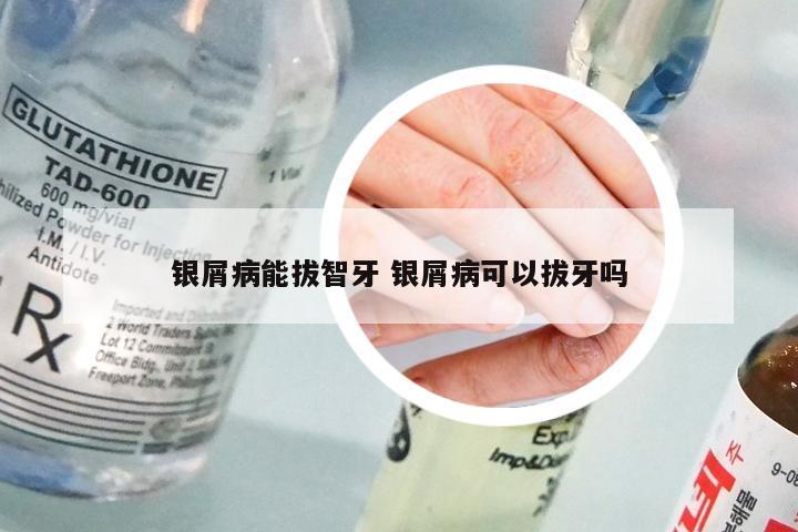 银屑病能拔智牙 银屑病可以拔牙吗