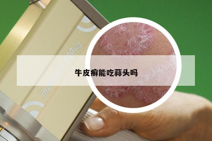 牛皮癣能吃蒜头吗