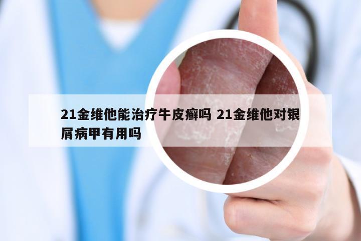 21金维他能治疗牛皮癣吗 21金维他对银屑病甲有用吗