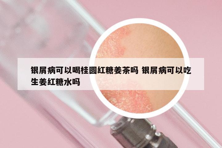 银屑病可以喝桂圆红糖姜茶吗 银屑病可以吃生姜红糖水吗