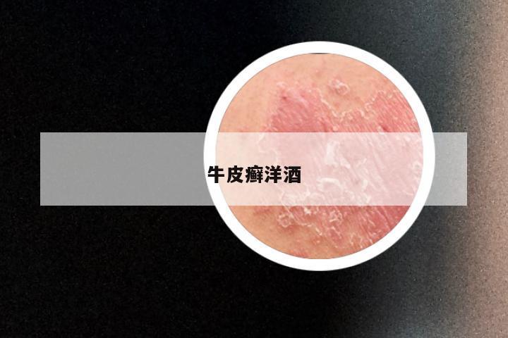 牛皮癣洋酒