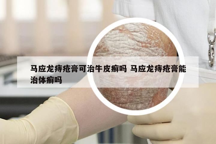 马应龙痔疮膏可治牛皮癣吗 马应龙痔疮膏能治体癣吗