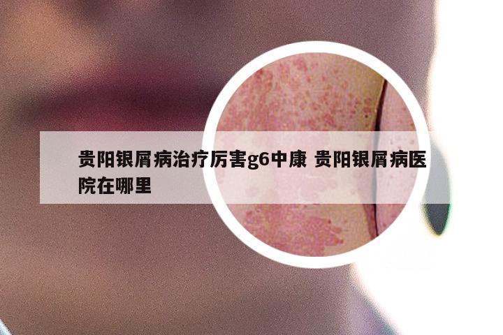 贵阳银屑病治疗厉害g6中康 贵阳银屑病医院在哪里