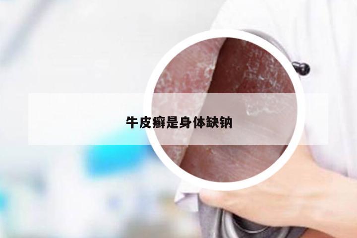 牛皮癣是身体缺钠