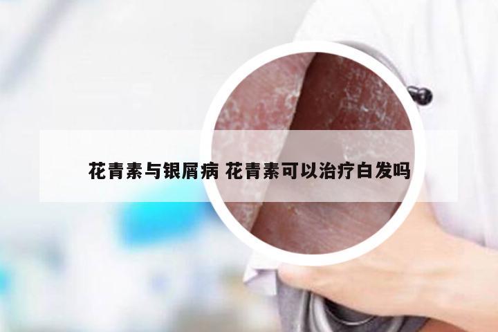 花青素与银屑病 花青素可以治疗白发吗