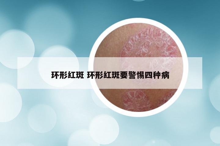 环形红斑 环形红斑要警惕四种病