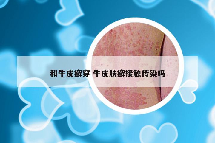 和牛皮癣穿 牛皮肤癣接触传染吗
